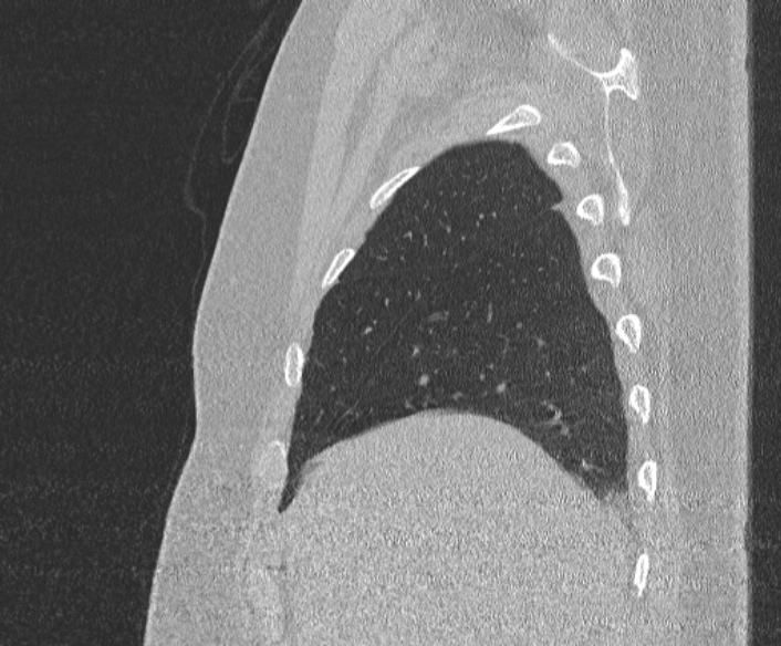 File:Adenoid cystic carcinoma of the trachea (Radiopaedia 49042-54137 Sagittal lung window 82).jpg