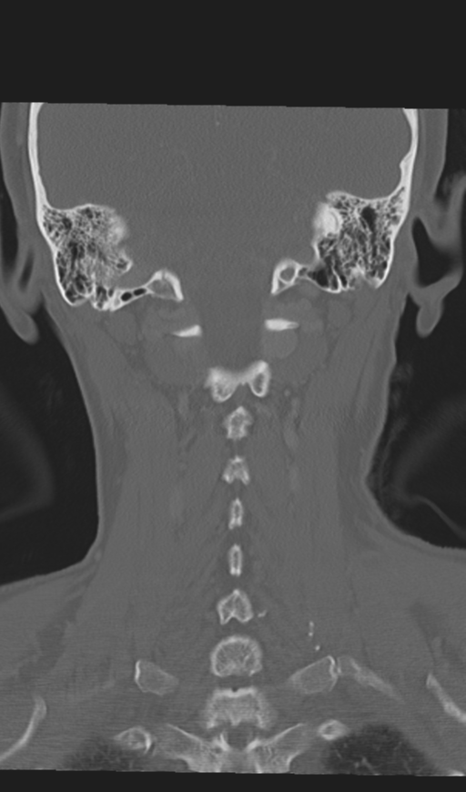 Adenoid cystic tumor of palate (Radiopaedia 46980-51518 Coronal bone window 47).png