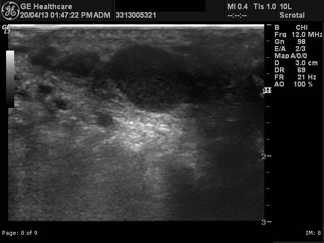 File:Adenomatoid tumor of the scrotum (Radiopaedia 22739-22762 F 1).jpg