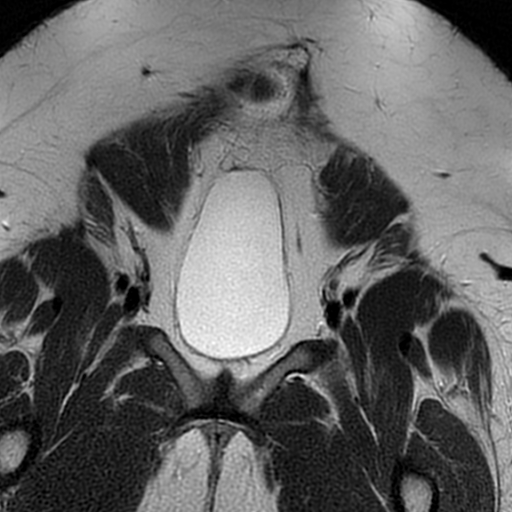 File:Adenomyosis within a didelphys uterus (Radiopaedia 70175-80215 Coronal T2 6).jpg