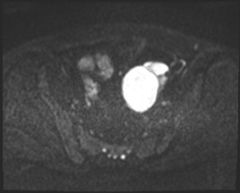 Adnexal multilocular cyst (O-RADS US 3- O-RADS MRI 3) (Radiopaedia 87426-103754 Axial DWI 40).jpg