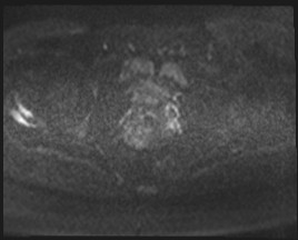 Adnexal multilocular cyst (O-RADS US 3- O-RADS MRI 3) (Radiopaedia 87426-103754 Axial DWI 80).jpg