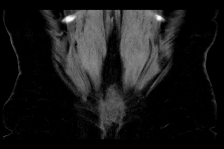 Adrenal cortical carcinoma (Radiopaedia 64017-72769 Coronal non-contrast 54).jpg