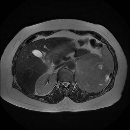 File:Adrenal cortical carcinoma (Radiopaedia 70906-81116 Axial T2 13).jpg