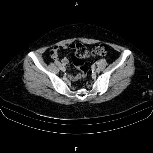 Adrenal cortical carcinoma (Radiopaedia 84882-100379 Axial C+ delayed 77).jpg