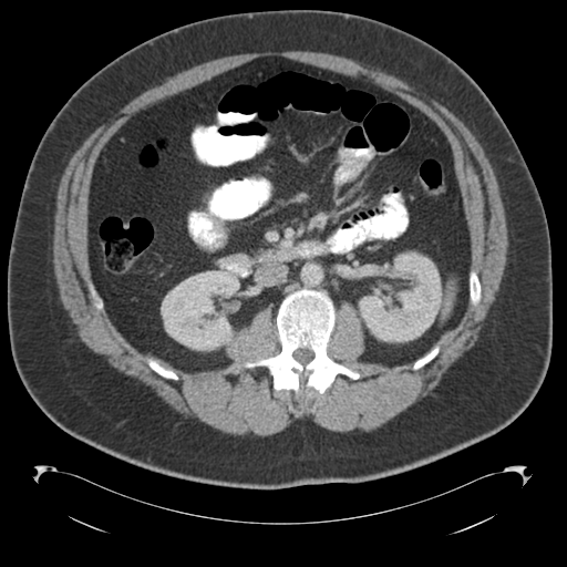 File:Adrenal cyst (Radiopaedia 45625-49776 Axial C+ portal venous phase 43).png