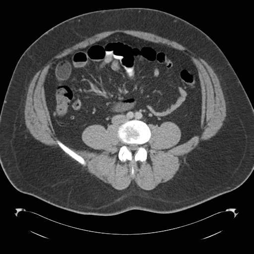Adrenal cyst (Radiopaedia 45625-49776 Axial C+ portal venous phase 60).png