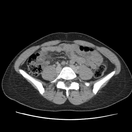 Adrenal cyst (Radiopaedia 64869-73813 Axial C+ portal venous phase 50).jpg