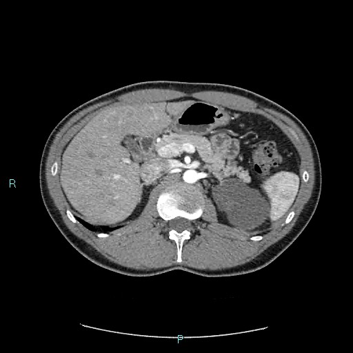 Adrenal cystic lymphangioma (Radiopaedia 83161-97534 Axial C+ arterial phase 31).jpg