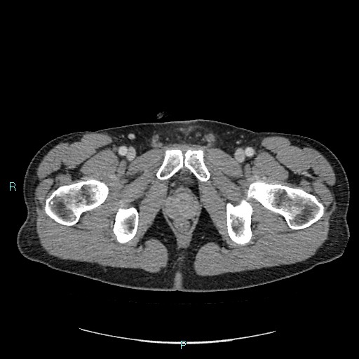 Adrenal cystic lymphangioma (Radiopaedia 83161-97534 Axial C+ portal venous phase 101).jpg