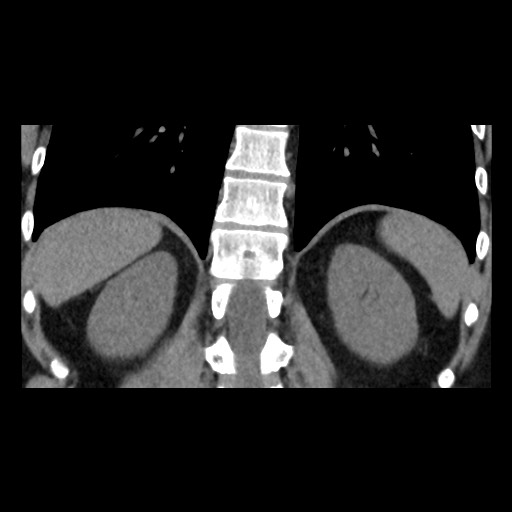 Adrenal gland trauma (Radiopaedia 81351-95079 Coronal non-contrast 66).jpg