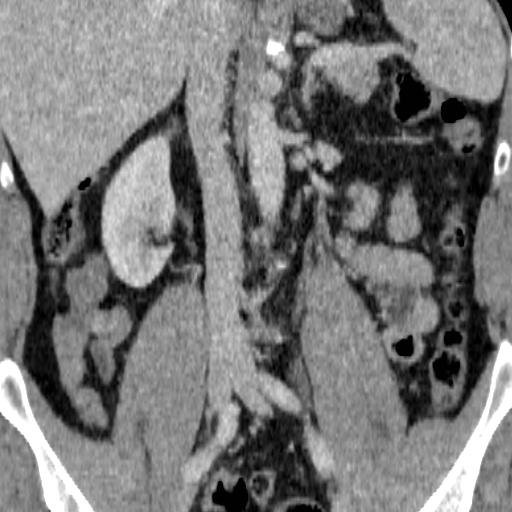 File:Adrenal glands (normal CT anatomy) (Radiopaedia 16570-105725 Coronal 1).jpg