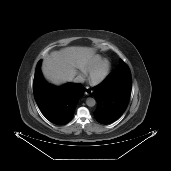 Adrenal myelolipoma (Radiopaedia 26278-26407 Axial non-contrast 1).jpg