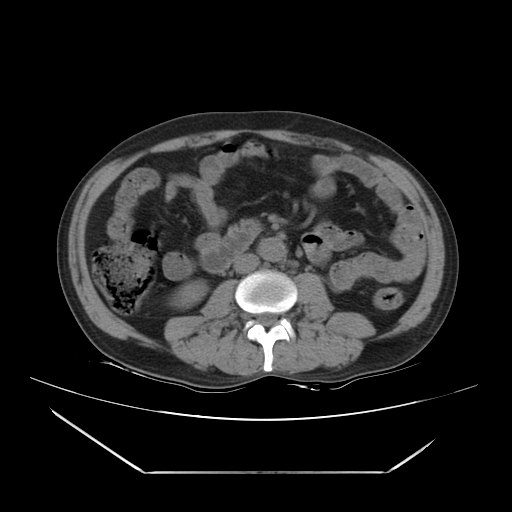 File:Adrenal myelolipoma (Radiopaedia 41843-44834 Axial non-contrast 42).jpg