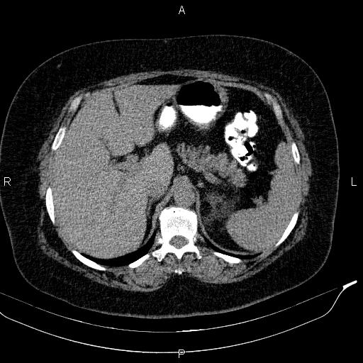 Adrenal myelolipoma (Radiopaedia 84319-99617 Axial With oral contrast 57).jpg
