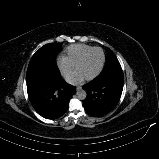 File:Adrenal myelolipoma (Radiopaedia 84319-99617 Axial With oral contrast 9).jpg