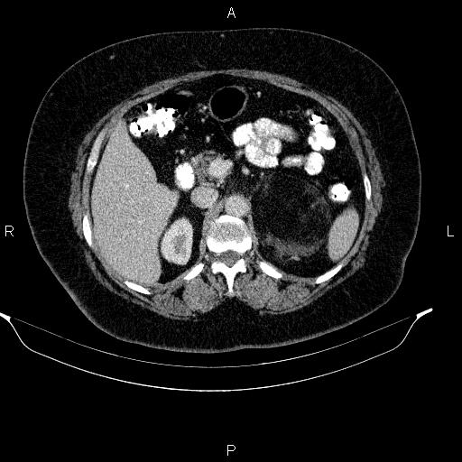 Adrenal myelolipoma (Radiopaedia 84319-99617 Axial renal cortical phase 41).jpg