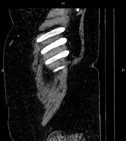 File:Adrenal myelolipoma (Radiopaedia 84319-99617 Sagittal renal cortical phase 2).jpg