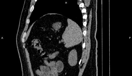 File:Adrenal myelolipoma (Radiopaedia 84321-99619 Sagittal non-contrast 90).jpg