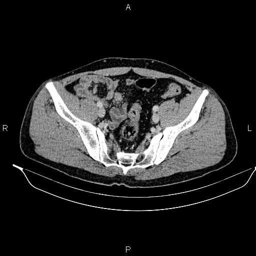 Adrenal myelolipoma (Radiopaedia 87794-104246 Axial renal cortical phase 87).jpg