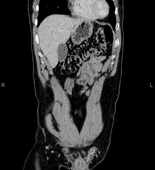 Adrenal myelolipoma (Radiopaedia 87794-104246 Coronal renal cortical phase 11).jpg