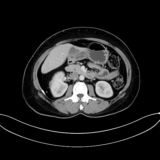 File:Adrenocortical carcinoma (Radiopaedia 87281-103569 Axial C+ portal venous phase 39).jpg