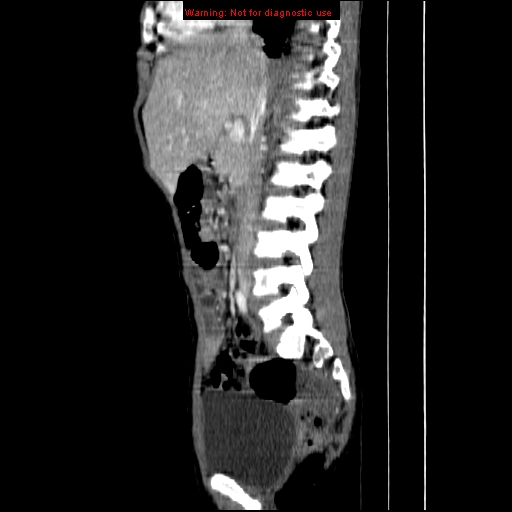 File:Adrenocortical carcinoma (Radiopaedia 9449-10131 Sagittal C+ portal venous phase 4).jpg