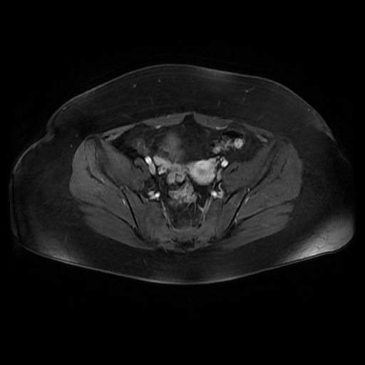 File:Adult granulosa cell tumor of the ovary (Radiopaedia 64991-73953 axial-T1 Fat sat post-contrast dynamic 36).jpg
