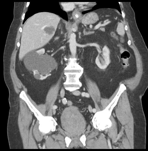 Adult ileal intussusception with secondary obstruction (Radiopaedia 30395-31051 Coronal C+ portal venous phase 35).jpg