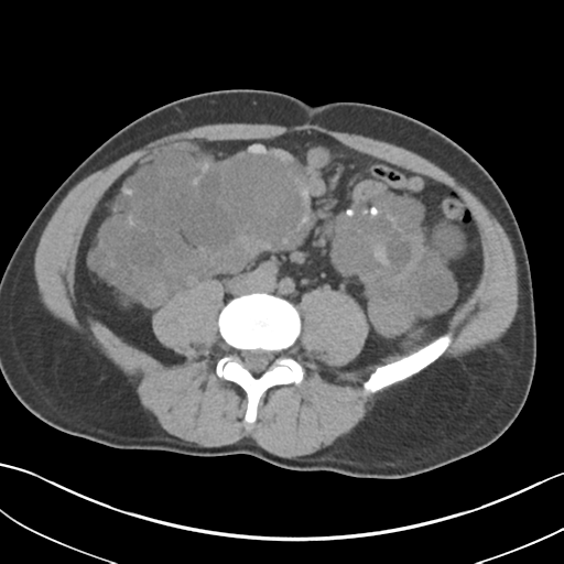 File:Adult polycystic kidney disease (Radiopaedia 47866-52626 Axial non-contrast 49).png