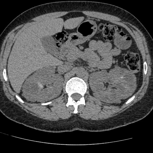 Adult polycystic kidney disease (Radiopaedia 59075-66368 Axial non-contrast 20).jpg