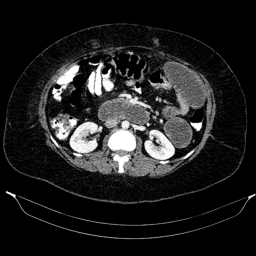 Afferent loop syndrome - secondary to incarcerated trocar site hernia (Radiopaedia 82959-97305 Axial C+ portal venous phase 104).jpg
