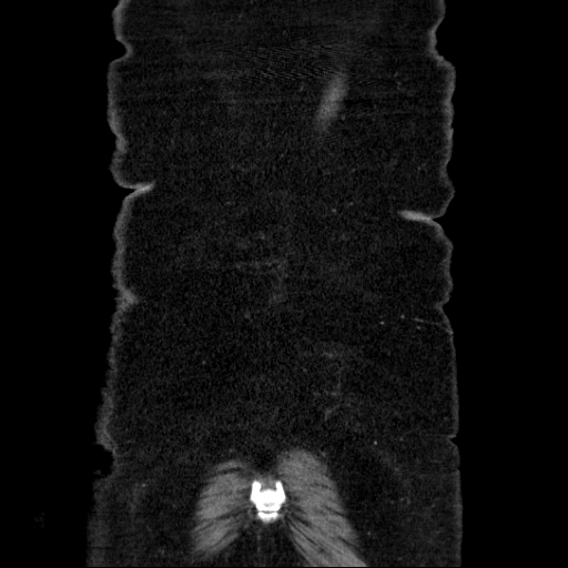 File:Afferent loop syndrome - secondary to incarcerated trocar site hernia (Radiopaedia 82959-97305 Coronal C+ portal venous phase 137).jpg
