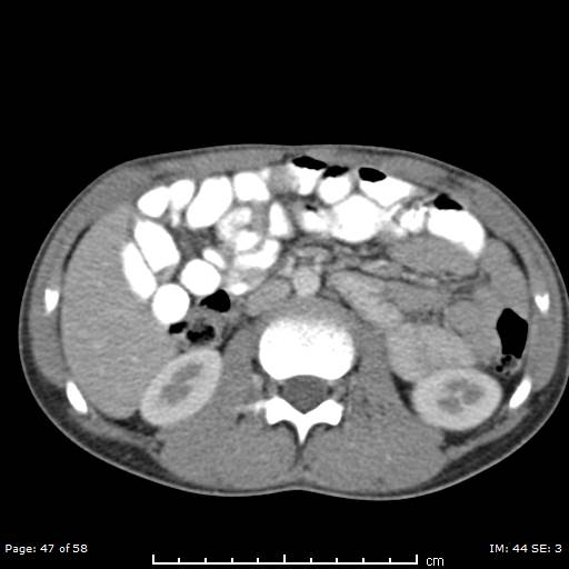 Agenesis of the gallbladder (Radiopaedia 55454-61905 B 47).jpg