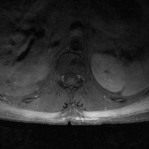 File:Aggressive vertebral hemangioma (Radiopaedia 39937-42404 Axial T1 C+ fat sat 6).png