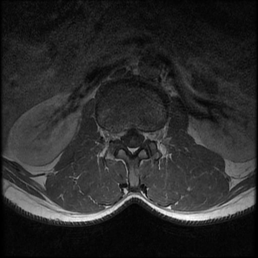 File:Aggressive vertebral hemangioma with pathological fracture (Radiopaedia 69528-79411 Axial T1 C+ 10).jpg