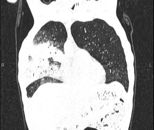 Air bronchogram in pneumonia (Radiopaedia 85719-101512 Coronal lung window 15).jpg