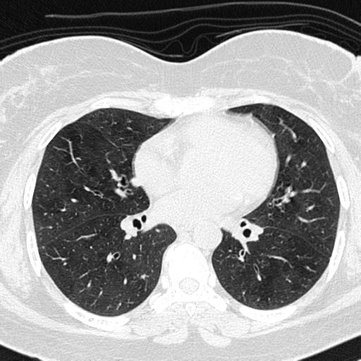 Air trapping in small airway disease (Radiopaedia 61685-69694 Axial lung window 88).jpg