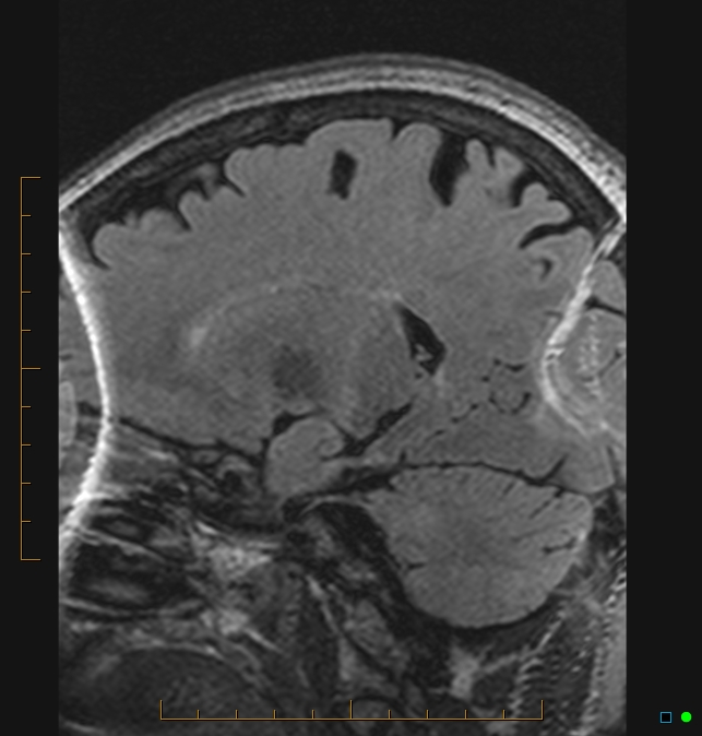 Aliasing artifact causing a spurious cerebellar lesion (Radiopaedia 48783-53810 Sagittal FLAIR 73).jpg