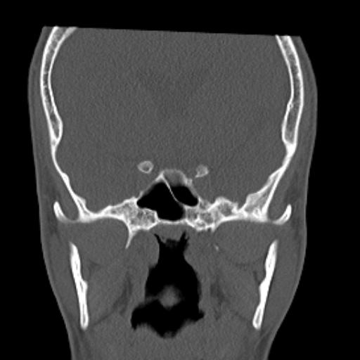 File:Allergic fungal sinusitis (Radiopaedia 29086-29455 Coronal bone window 5).jpg