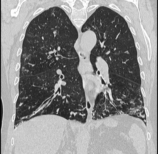 Alpha-1-antitrypsin deficiency (Radiopaedia 72058-82557 Coronal lung window 53).jpg