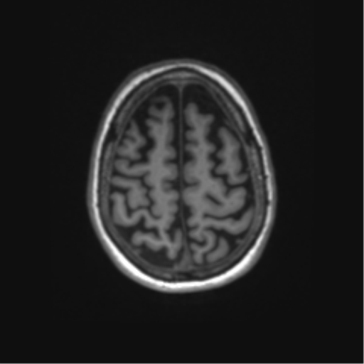 File:Alzheimer's disease (Radiopaedia 42658-45802 Axial T1 34).png
