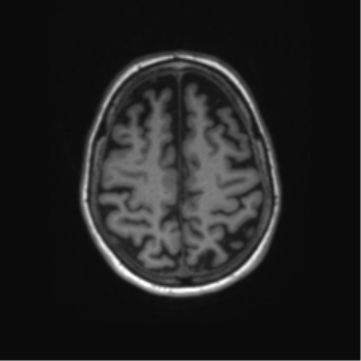 File:Alzheimer's disease (Radiopaedia 42658-45802 Axial T1 42).png