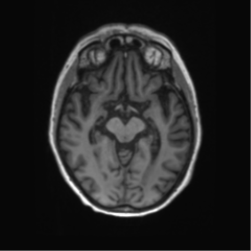 File:Alzheimer's disease (Radiopaedia 42658-45802 Axial T1 91).png
