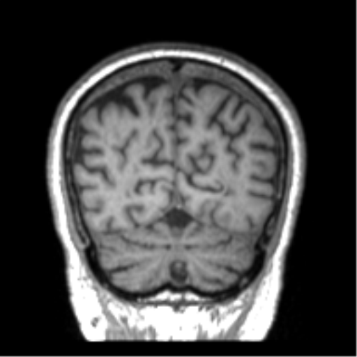 File:Alzheimer disease and cerebral amyloid angiopathy (Radiopaedia 64234-73011 Coronal T1 5).png
