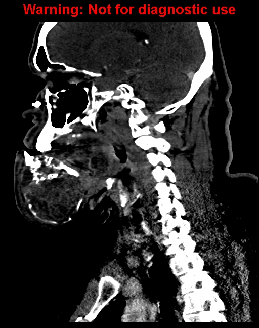 Ameloblastoma (Radiopaedia 33126-34164 F 42).jpg