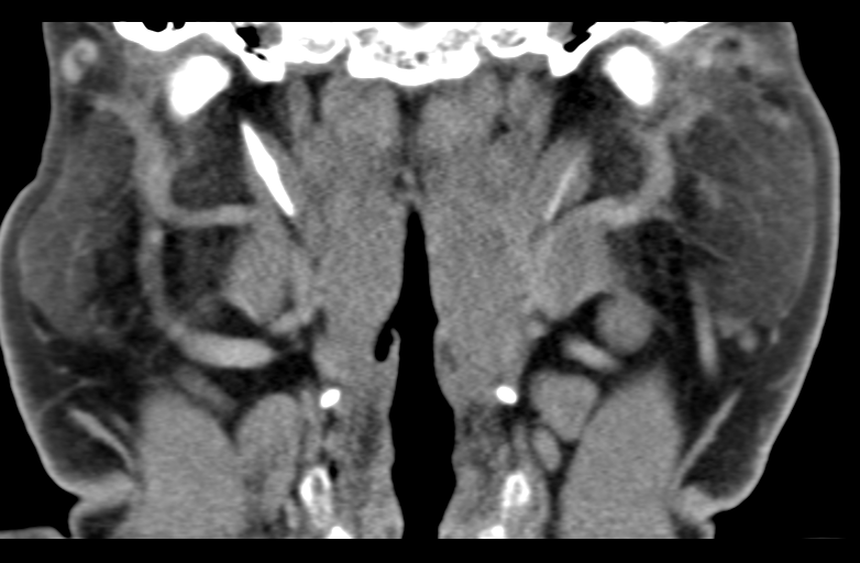 File:Ameloblastoma (Radiopaedia 33677-34806 Coronal non-contrast 41).png