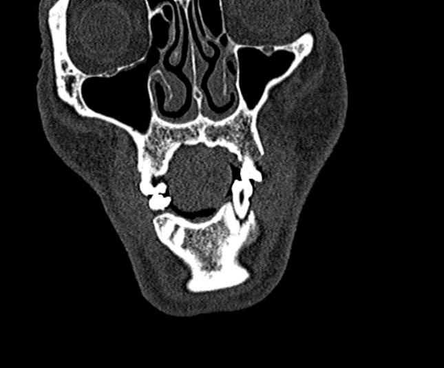 Ameloblastoma (Radiopaedia 51921-57766 Coronal bone window 39).jpg