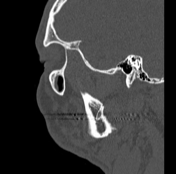 Ameloblastoma (Radiopaedia 77750-89997 Sagittal bone window 91).jpg