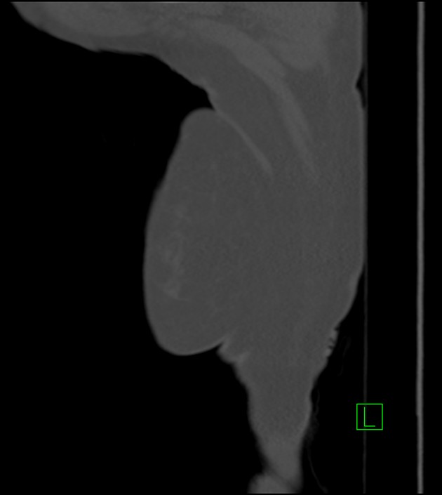 Amiodarone deposition in the liver (Radiopaedia 77587-89780 Sagittal bone window 100).jpg